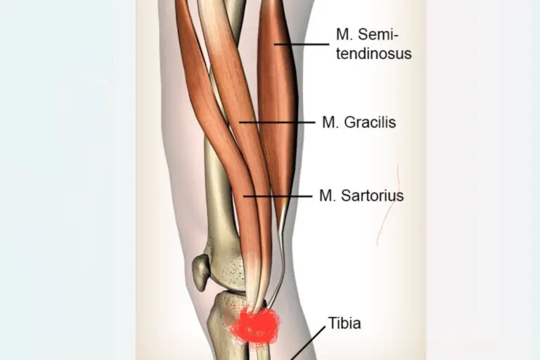 Pes anserinus bursitis - a térd belső oldalának fájdalma