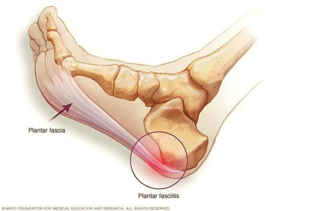 Plantar fasciitis - modern kezelési módszerek