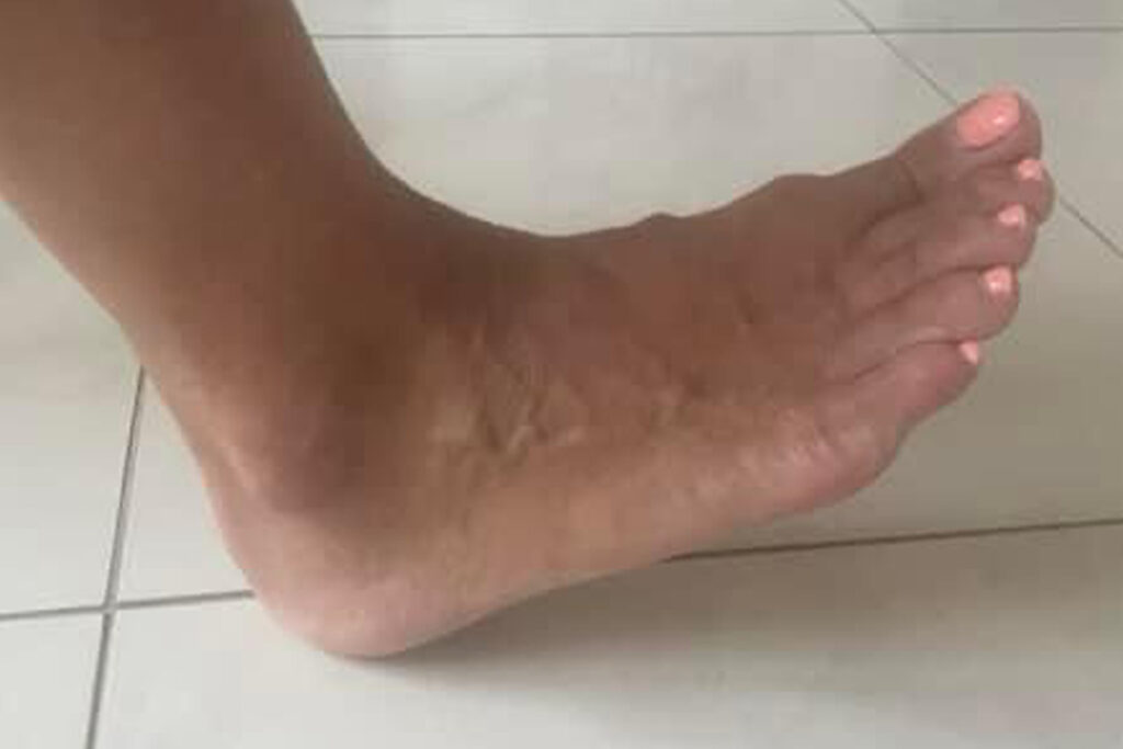 Sarokfájdalom, plantar fasciitis