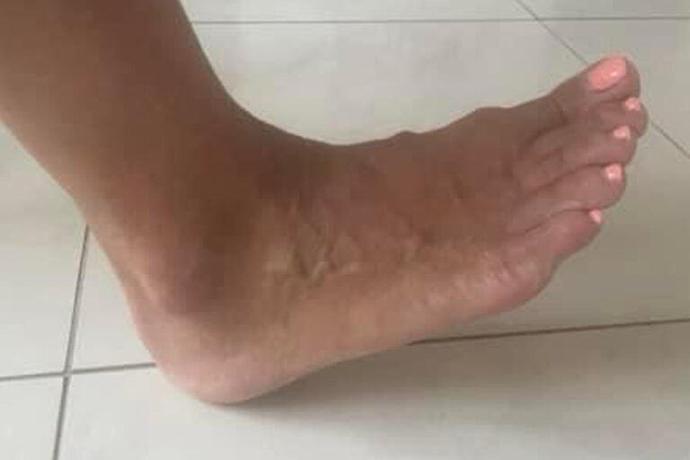 Sarokfájdalom, plantar fasciitis